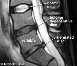 PE-HerniatedLumbar_Figure2a.jpg