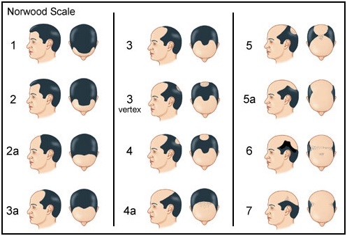 hair_replacement_therapy.jpg