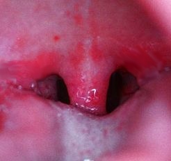 chronic-sore-throat.jpg