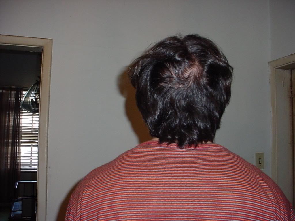 antes-15diasback.jpg