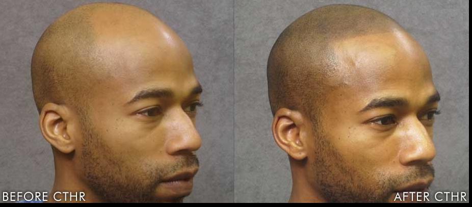 hair-micropigmentation.jpg