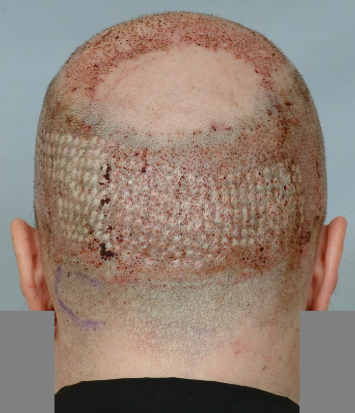 scarred_donor.jpg