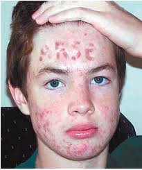 severe-acne-treatment.jpeg