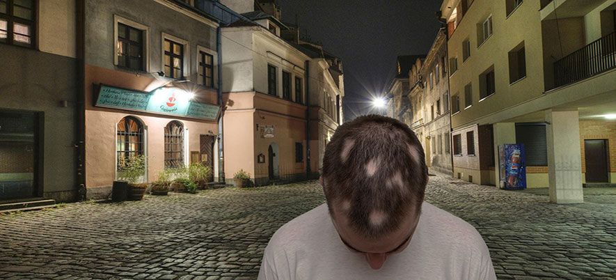 Alopecia Areata Information