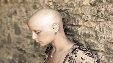 Alopecia Areata Totalis Universalis