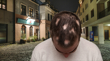 Alopecia Areata Guide