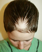 Childrens Alopecia Areata