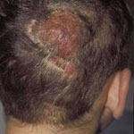 Childrens Tinea Capitis
