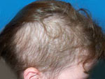 Childrens Trichotillomania