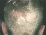 Tinea Capitis