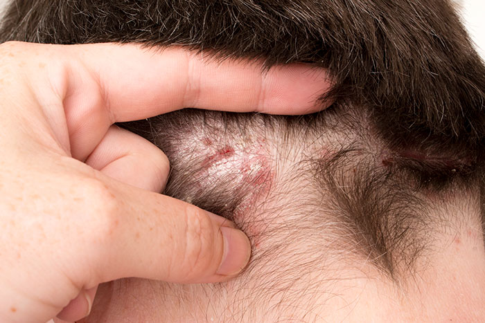 Psoriasis of the Scalp
