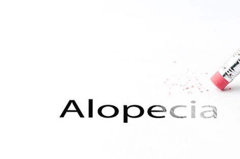 Alopecia Areata Cure?  Aclaris Therapeutics JAK3 Inhibitors.