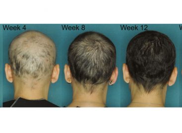 New Study Confirms JAK3 Effective in Alopecia Areata