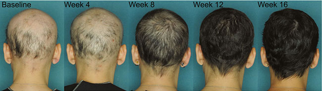 JAK3 Inhibitors Alopecia