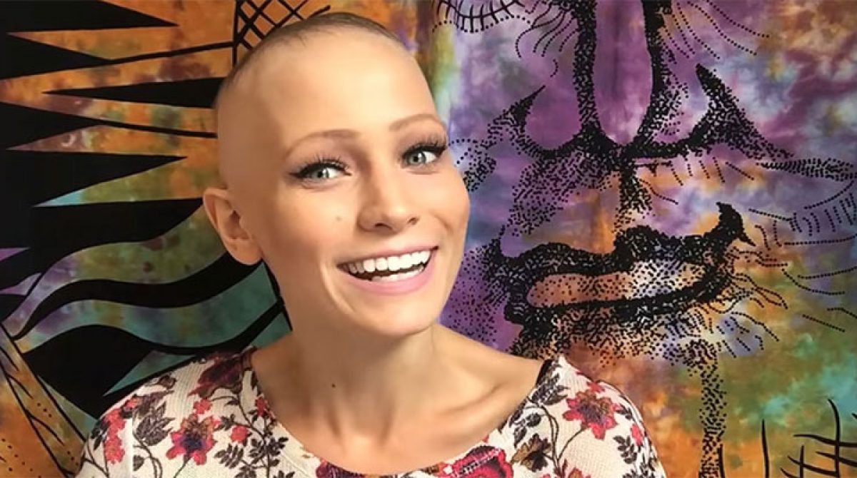 22 Year Old Alopecia Areata Spokeswoman: Abby Andrew