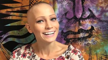 22 Year Old Alopecia Areata Spokeswoman: Abby Andrew
