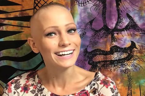 22 Year Old Alopecia Areata Spokeswoman: Abby Andrew