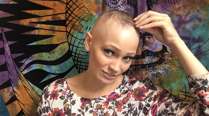 Alopecia Areata Thin Hair