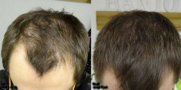 RU58841 Before After