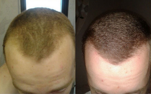 RU58841 Before After