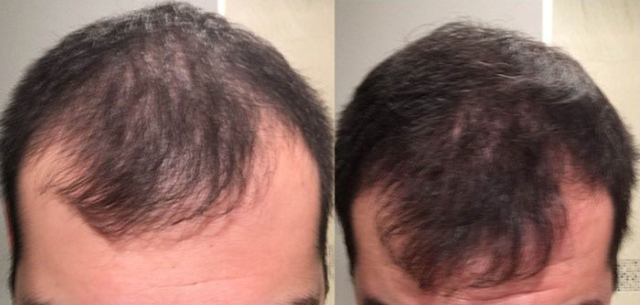 RU58841 Before After