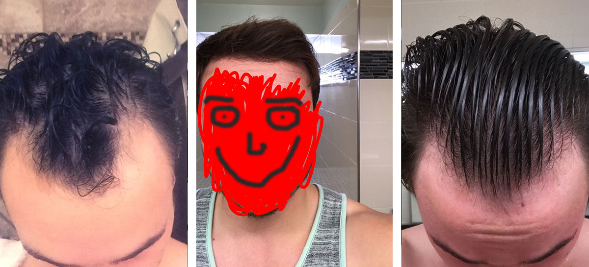 Is it Really Possible to Regrow Your Hair?  This Guy Did.