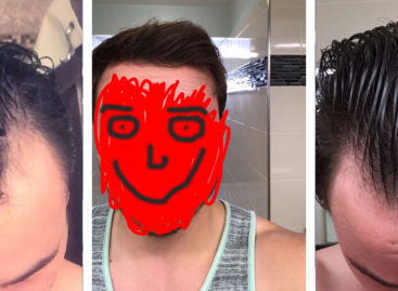 Is it Really Possible to Regrow Your Hair?  This Guy Did.