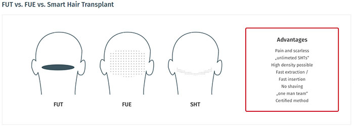 tissuse smart hair transplant